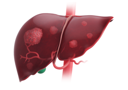 Liver Cancer